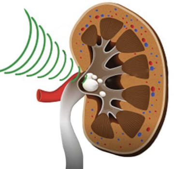 Cistolitotricia neumática y láser