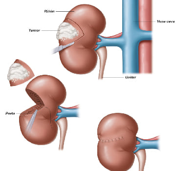 Nefrectomía simple y radical