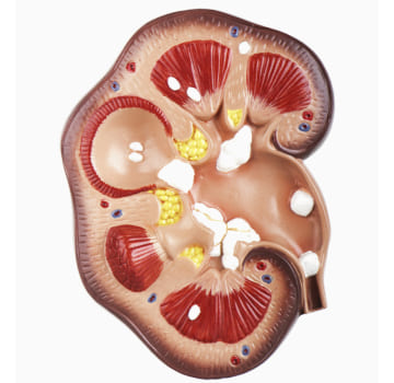 Nefrolitotricia Percutánea