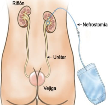 Nefrostomía Percutánea