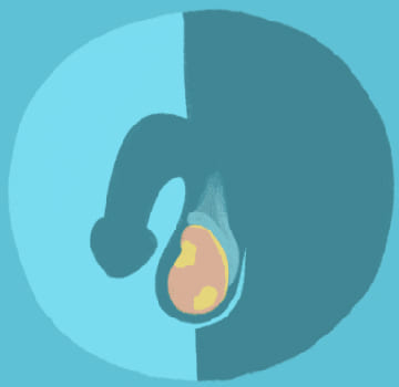 Orquiectomía simple y radical