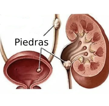Pielolitotomia laparoscópica y abierta