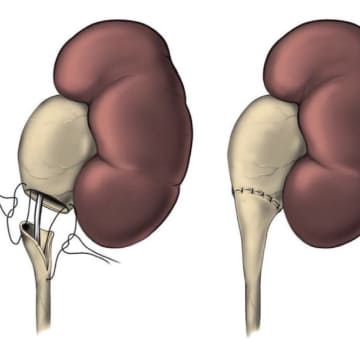 Pieloplastia laparoscópica y abierta
