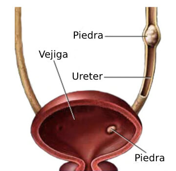 Ureterolitotimia laparoscópica y abierta